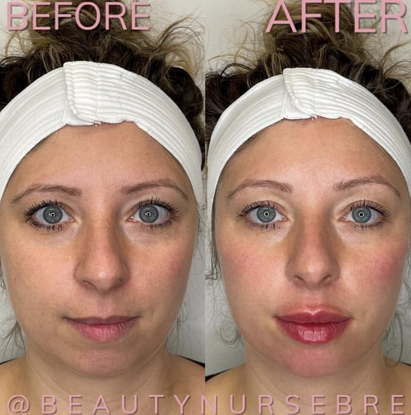 before and after dermal fillers medical spa reading massachusetts ma beautynursebre