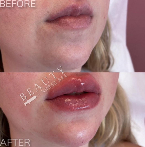 before and after dermal fillers services medical spa reading massachusetts ma beautynursebre