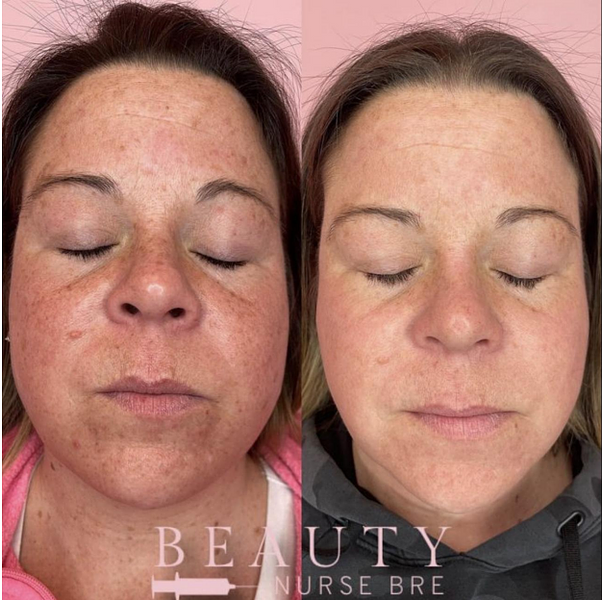before and after laser treatment medical spa reading massachusetts ma beautynursebre
