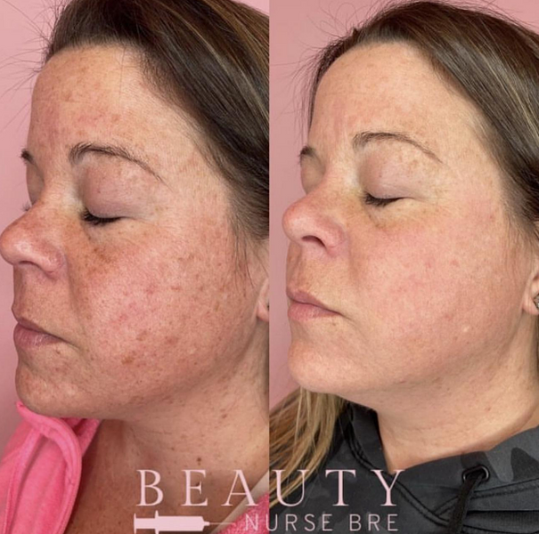 before and after laser treatment service medical spa reading massachusetts ma beautynursebre