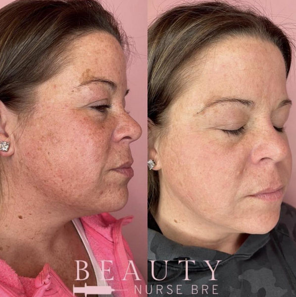 before and after laser treatments medical spa reading massachusetts ma beautynursebre