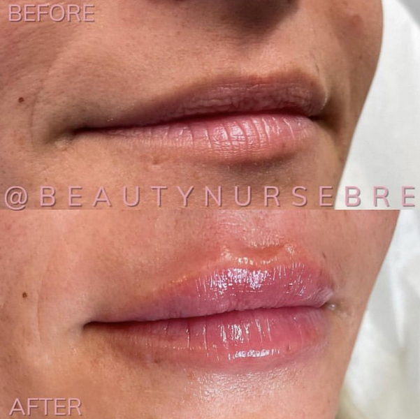 before and after dermal filler treamnet medical spa reading massachusetts ma beautynursebre