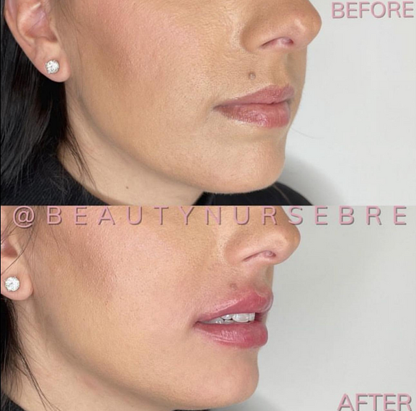 dermal filler before and after treatment medical spa reading massachusetts ma beautynursebre